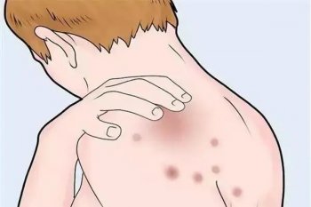 脚底长湿疹很痒怎么办